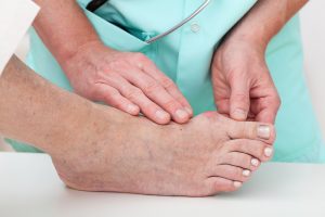 Bunions cause a painful, large bump at the base of the big toe