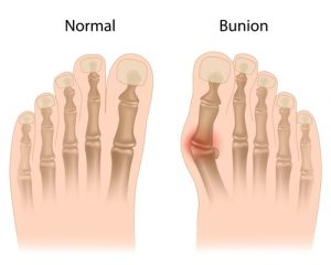 Comparison of a normal foot with a bunion