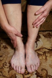 Treating Your Ankle Arthritis