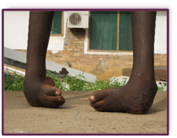 Learn about World Clubfoot Day!