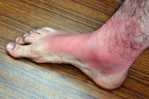 Sunburnt Feet