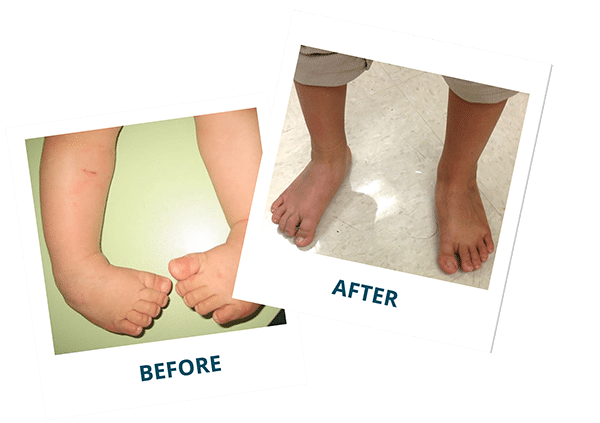 Clubfoot Before and After Photos