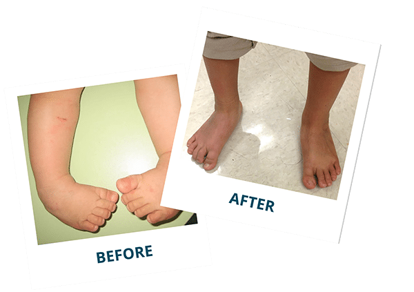 Clubfoot Before and After Photos