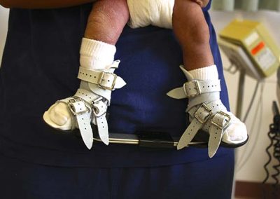 newborn after casting in Foot abduction brace