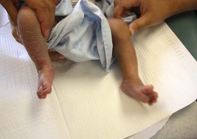 newborn clubfoot after 4th cast app