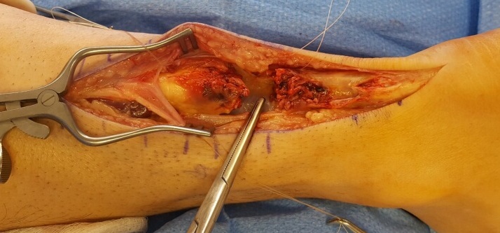2nd case Achilles tendon 1