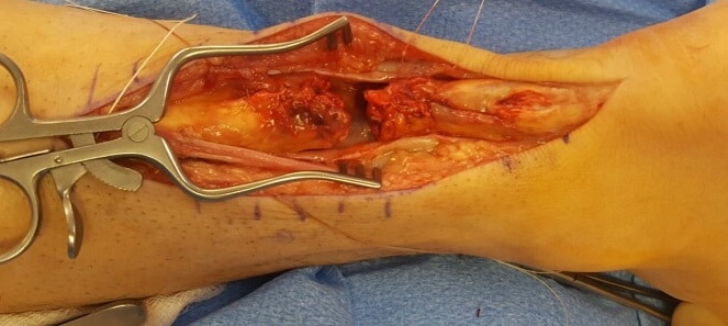 2nd case Achilles tendon 2