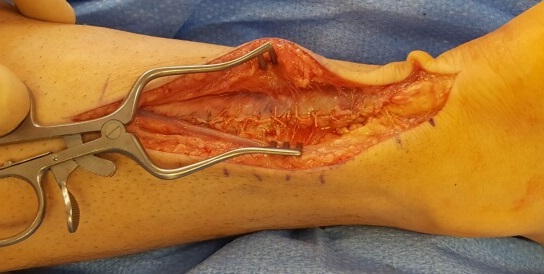 2nd case Achilles tendon 5