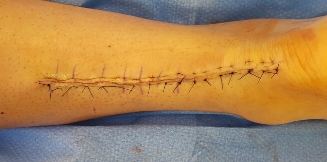 2nd case Achilles tendon 6