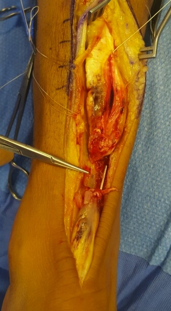 Achilles tendon pic 1