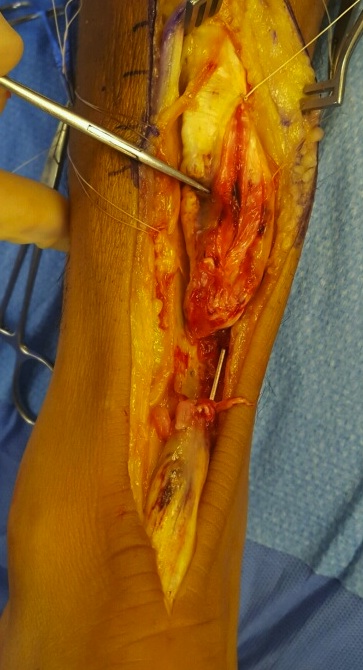 Achilles tendon pic 2