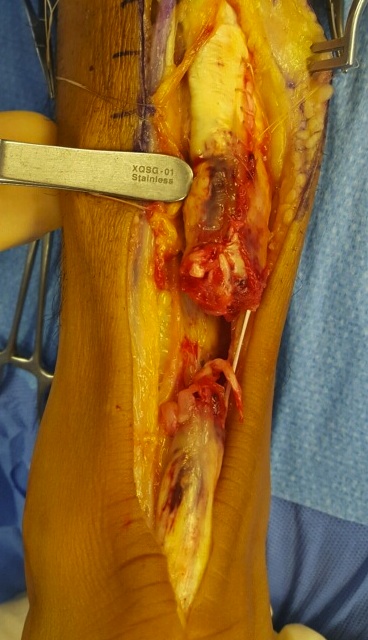 Achilles tendon pic 3