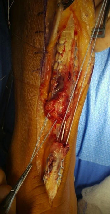 Achilles tendon pic 4