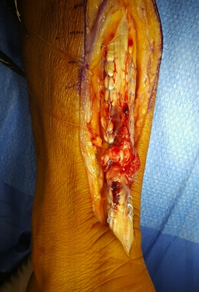 Achilles tendon pic 5
