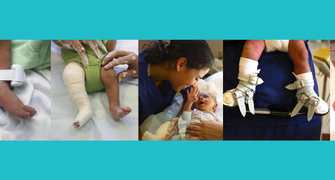 Family Matters When Treating Clubfoot