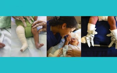 Family Matters When Treating Clubfoot