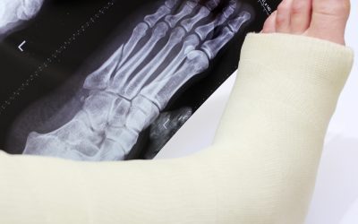 Foot and Ankle Fractures: Know the Symptoms and What to Do About Them