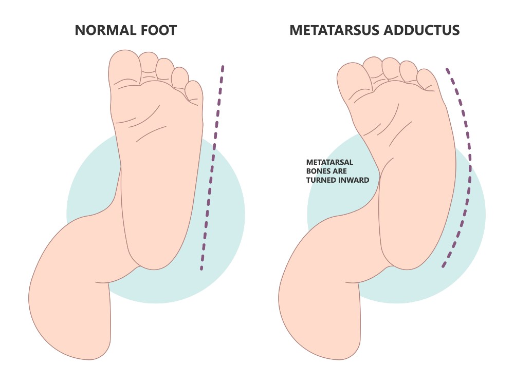 Metatarsus Adductus explained next to a normal foot