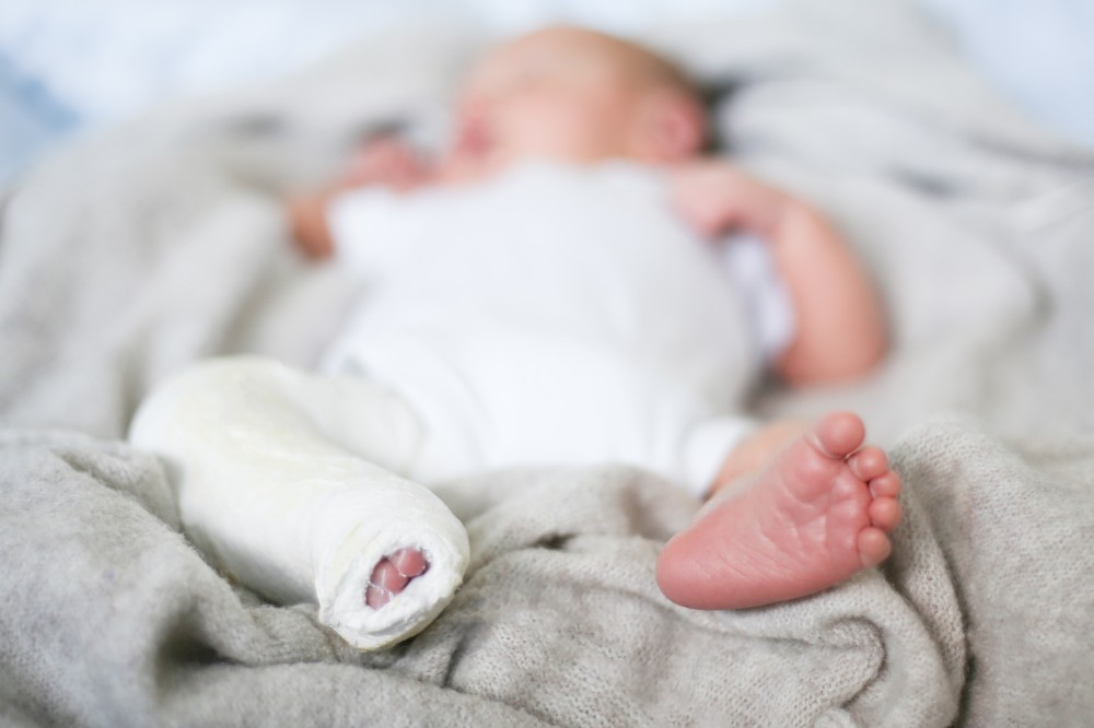 Baby foot in cast for clubfoot treatment