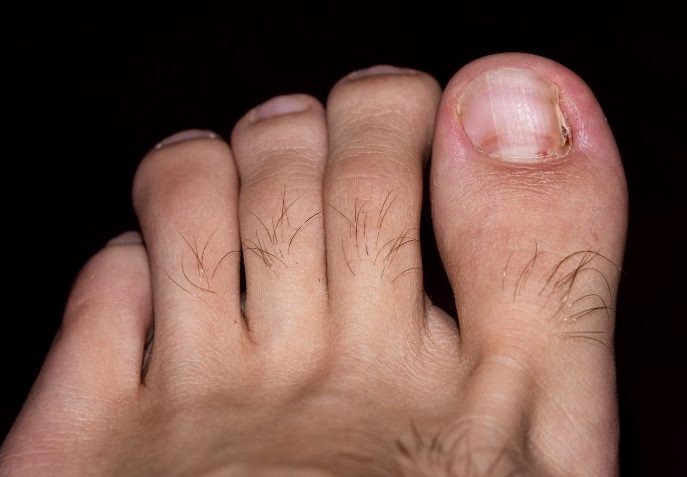 Foot with ingrown toenail