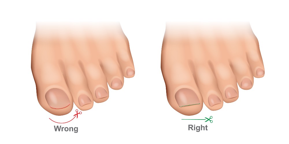 Trimming toenails correctly to prevent ingrown toenails