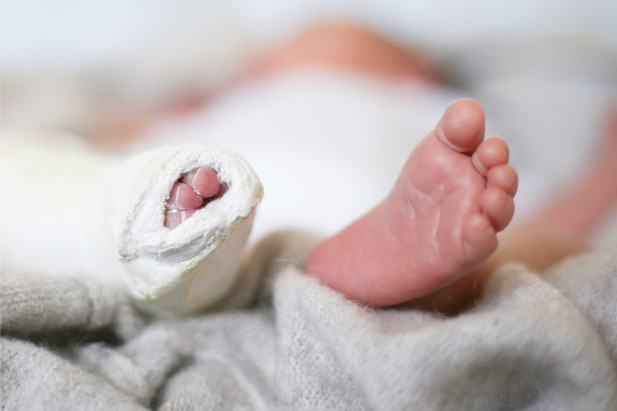 child's feet in a cast