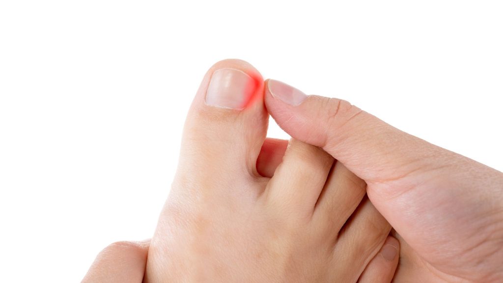 Why Do I Keep Getting Ingrown Toenails Southern California Foot