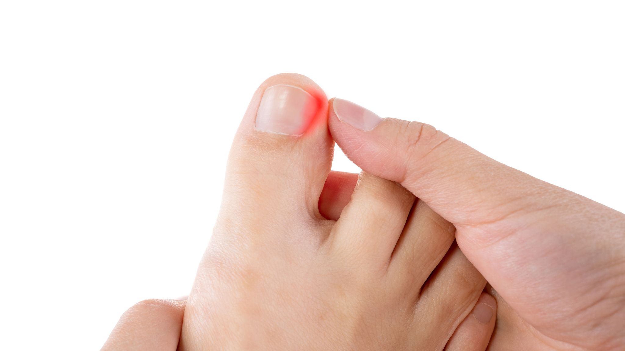 Ingrown toenails on a woman's foot, isolated on white background, pain in the big toe Ingrown toenails on a woman's foot, isolated on white background, pain in the big toe