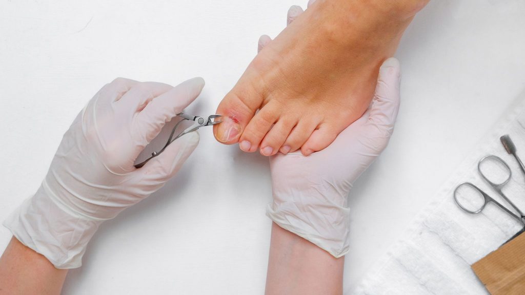 How to Prevent Ingrown Toenails - Southern California Foot & Ankle ...