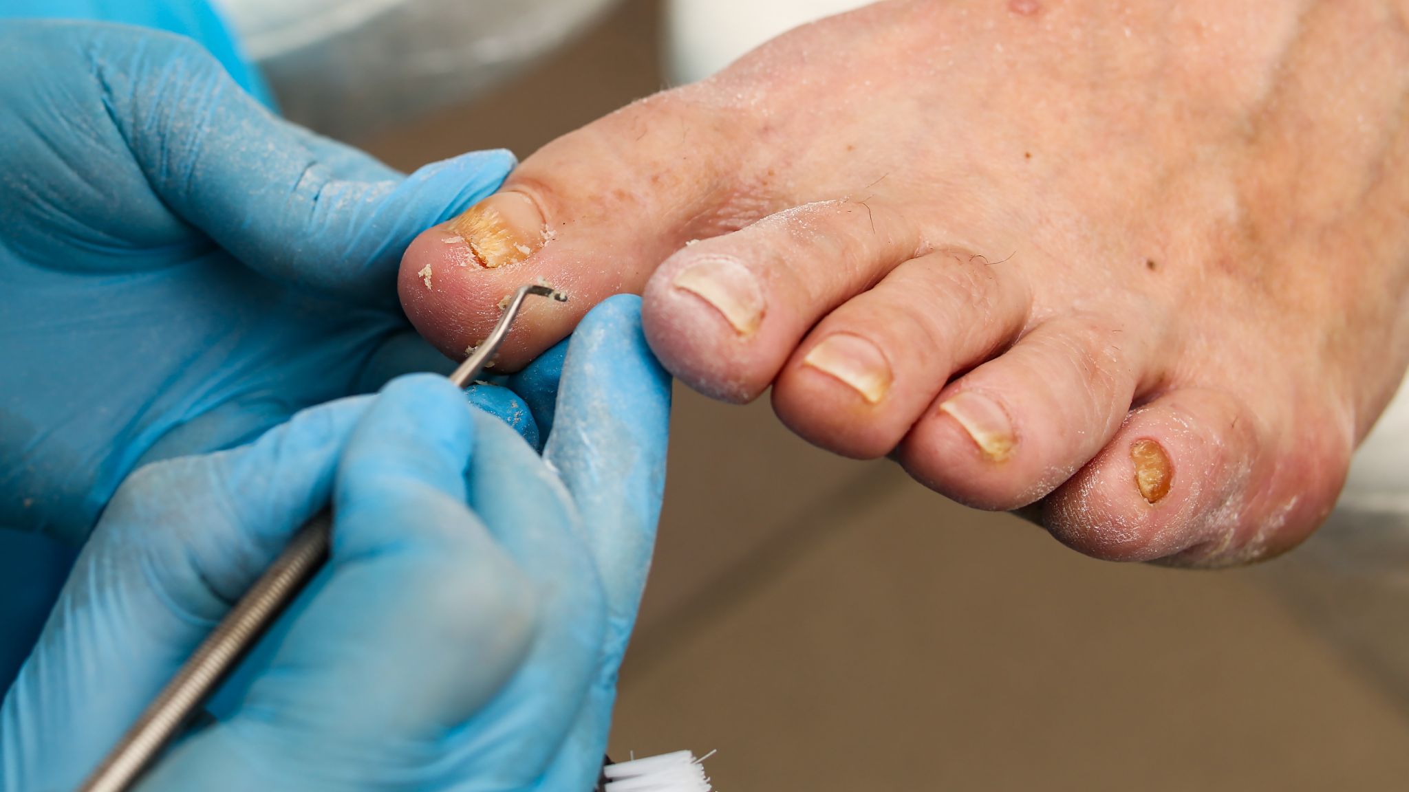 Treatment of an ingrown nail with a doctor's instrument, removal and disinfection