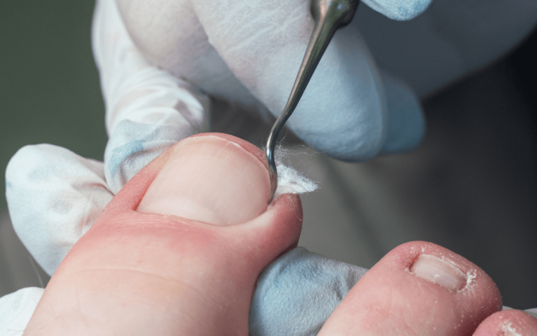 How to Avoid Ingrown Toenails