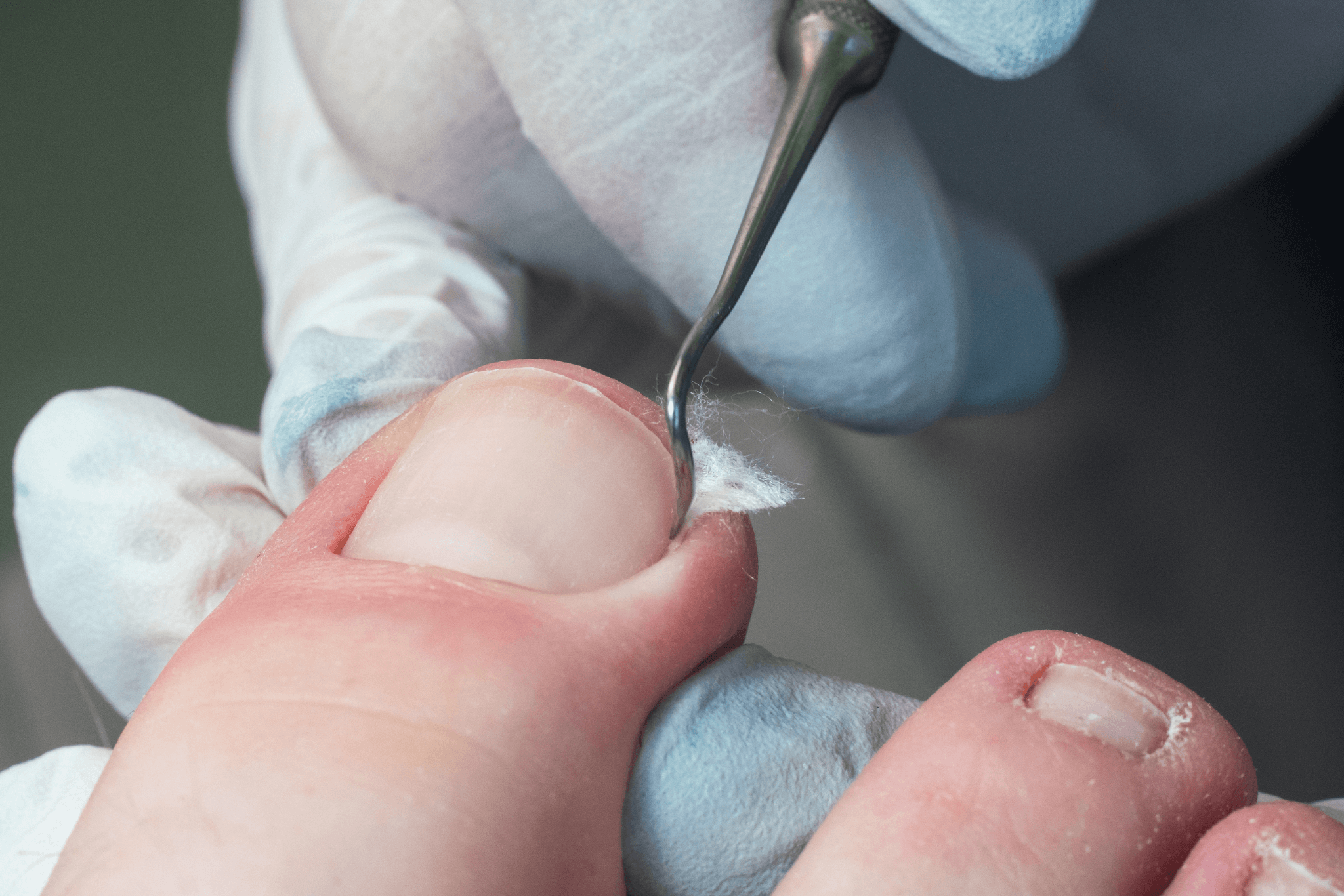 Fixing and lifting ingrown toenail Fixing and lifting ingrown toenail