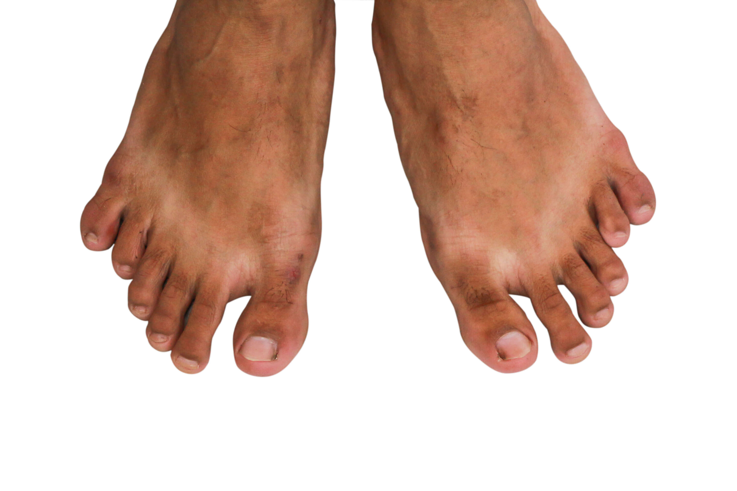 Foot with twelve toe. Polydactyly