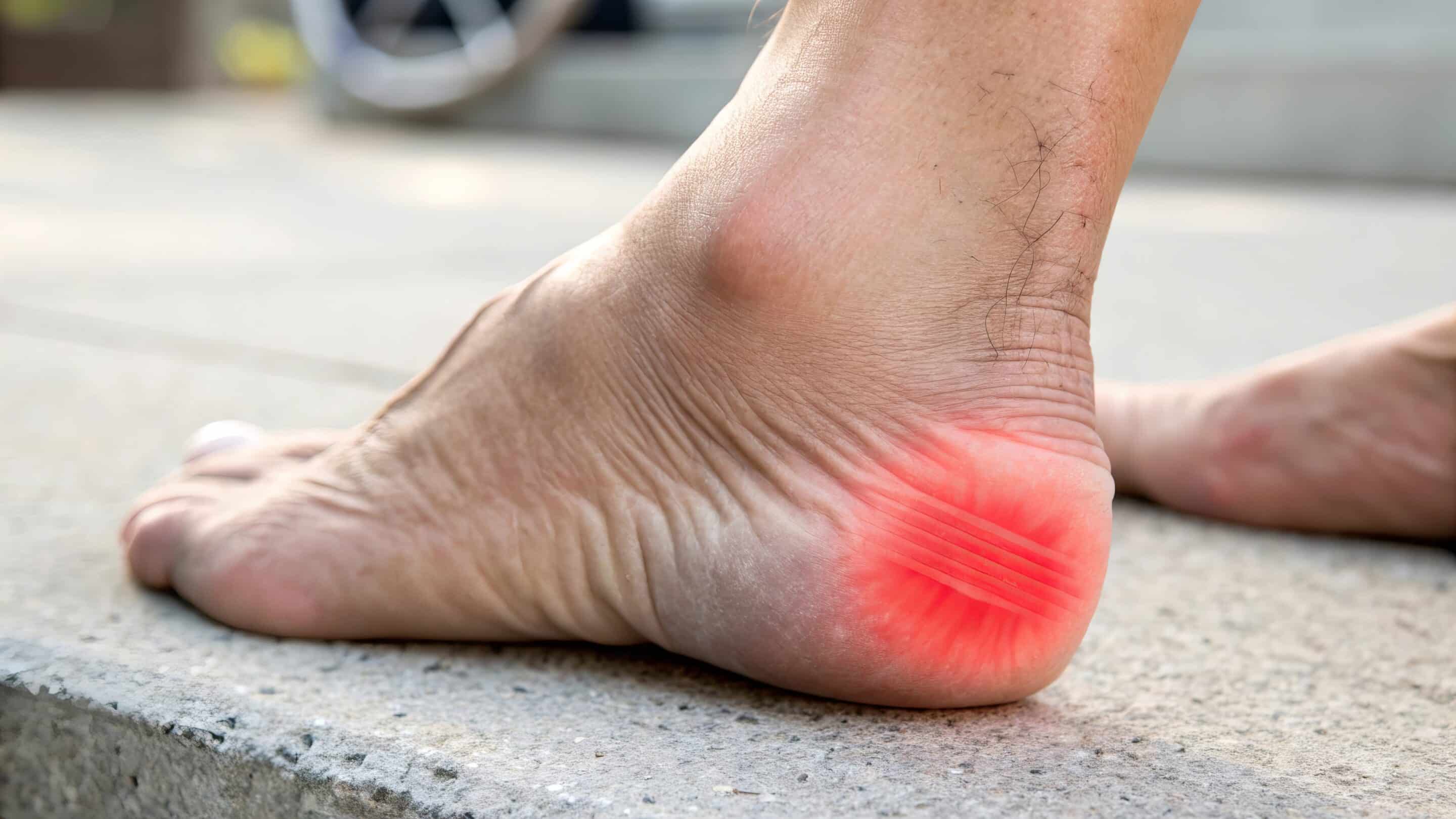Human foot, highlighting heel area in red color, symbolizing plantar fasciitis, heel spur, or chronic heel pain